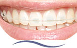Euroform Cosmetic Natural Tooth Coloured Archwires