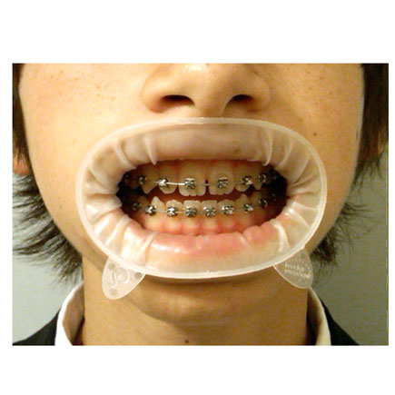 Optragate Small Disposable Lip and Cheek Retractors